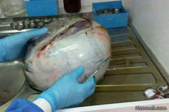 خارج کردن توده 8 کیلویی از شکم یک زن در شهر کرد + عکس